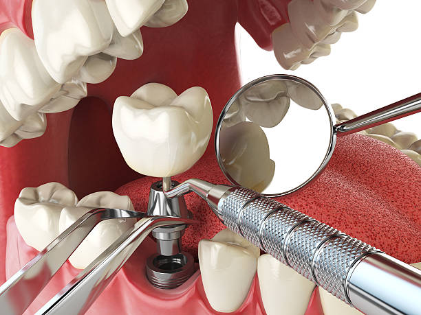 Best Emergency Dental Care for Broken or Chipped Teeth in Valley Springs, CA